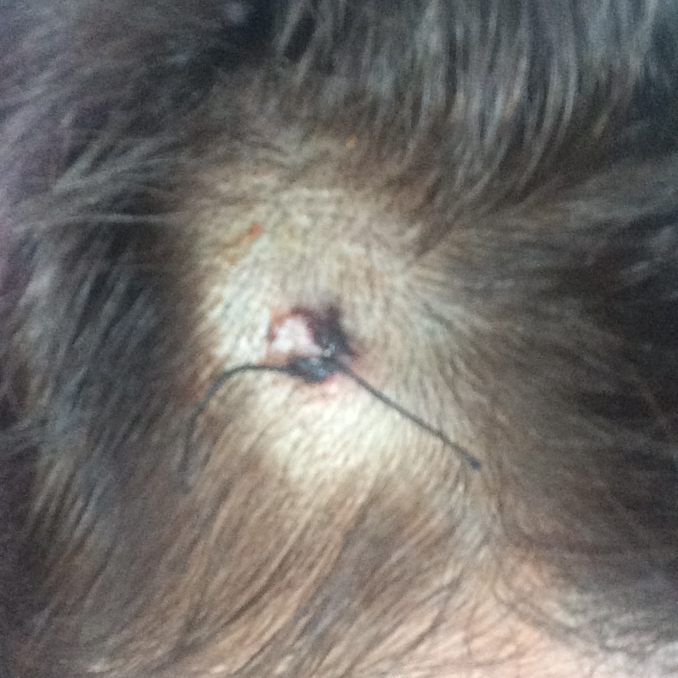A close-up view of a patch of Jenni's head, where the hair has been shaven and surgery has been performed.
